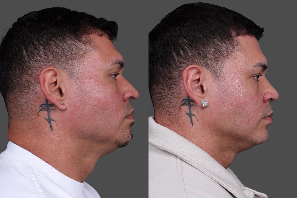 Rhinoplasty Before & After Gallery - Patient 534772 - Image 1