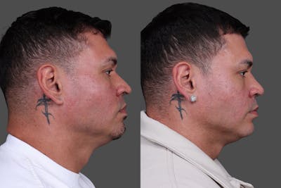 Rhinoplasty Before & After Gallery - Patient 534772 - Image 1