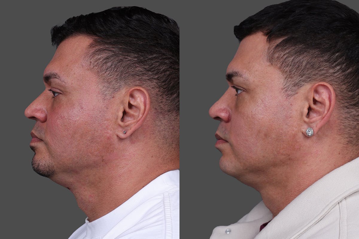 Rhinoplasty Before & After Gallery - Patient 534772 - Image 4