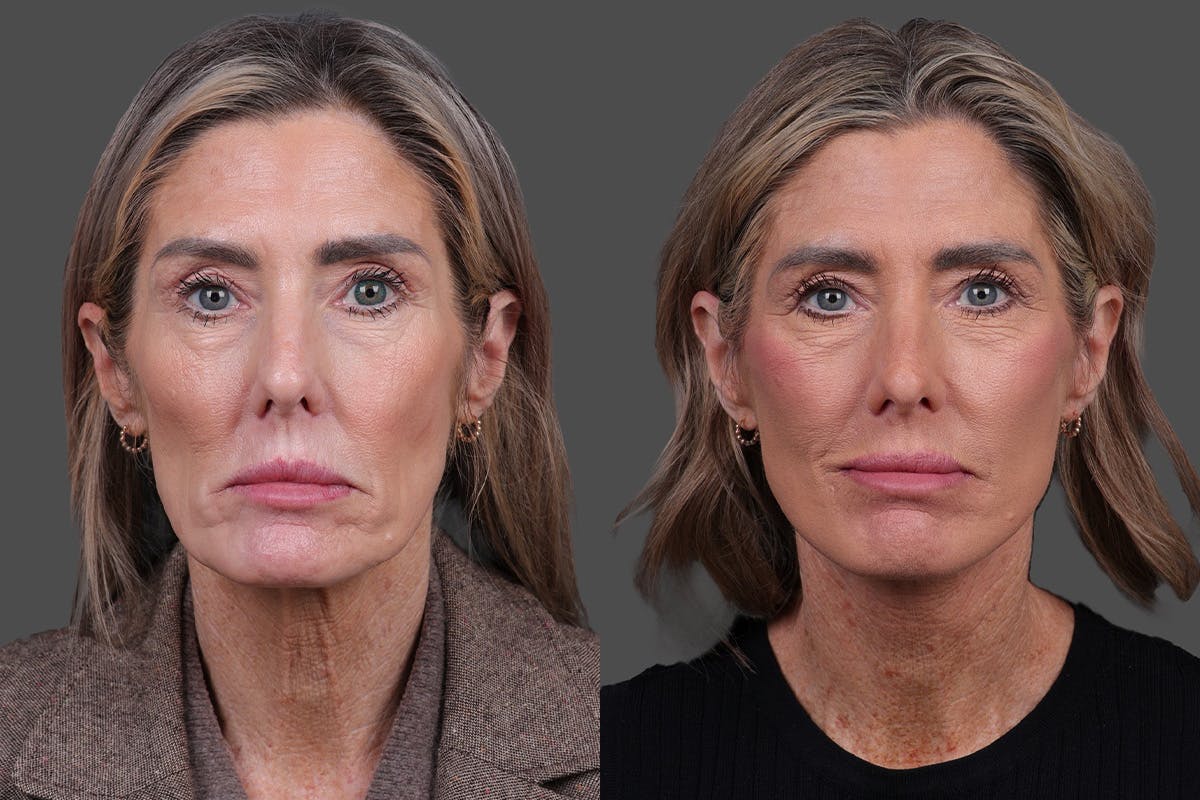 Facelift Before & After Gallery - Patient 288140 - Image 1
