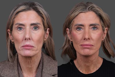 Facelift Before & After Gallery - Patient 288140 - Image 1