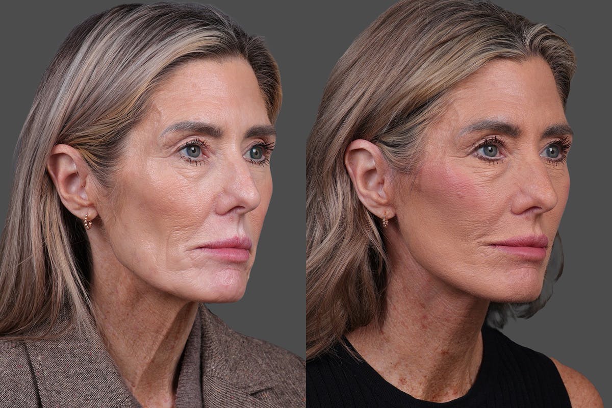 Facelift Before & After Gallery - Patient 288140 - Image 2
