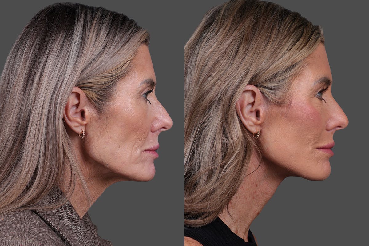 Facelift Before & After Gallery - Patient 288140 - Image 3