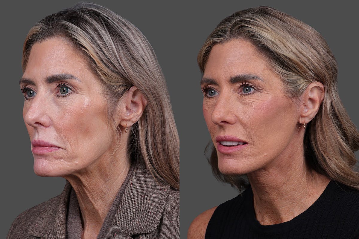 Facelift Before & After Gallery - Patient 288140 - Image 4