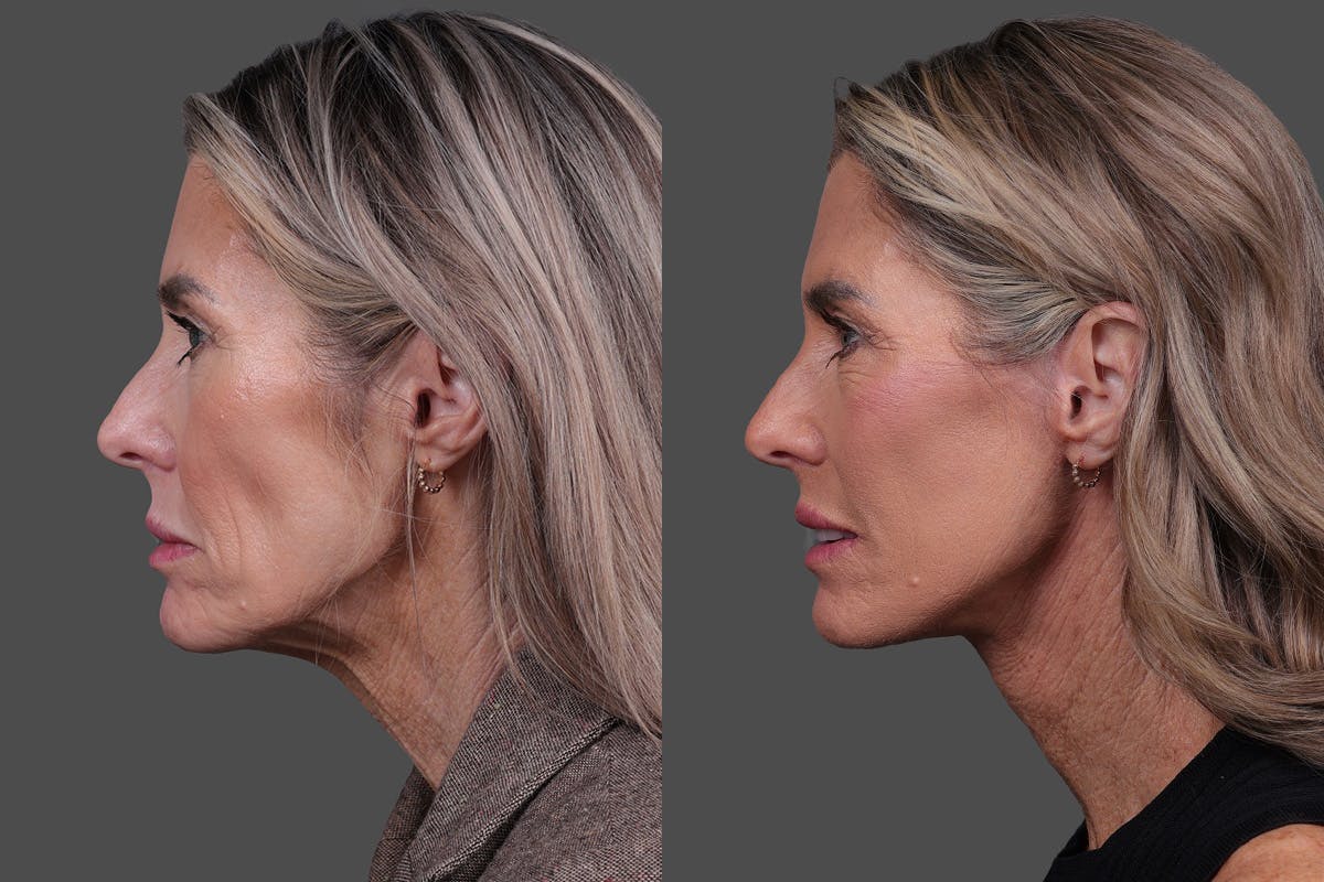 Facelift Before & After Gallery - Patient 288140 - Image 5