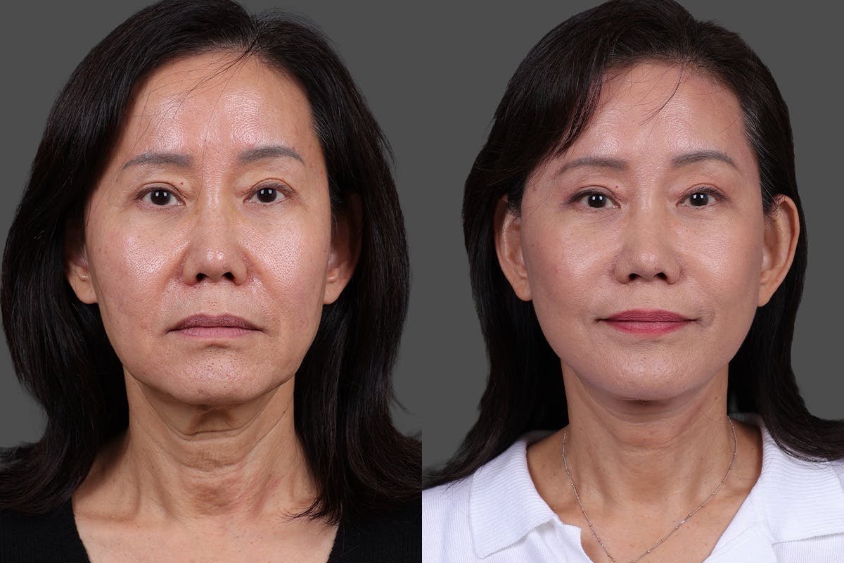 Facelift Before & After Gallery - Patient 231404 - Image 1