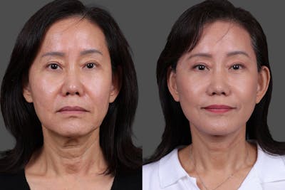 Facelift Before & After Gallery - Patient 231404 - Image 1