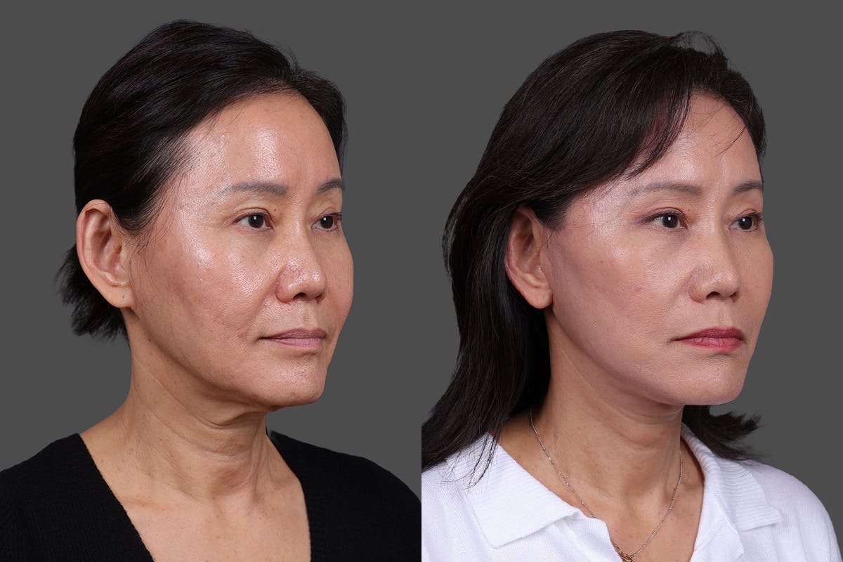 Facelift Before & After Gallery - Patient 231404 - Image 2