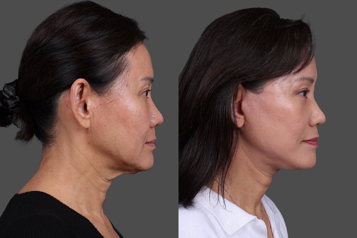 Facelift Before & After Gallery - Patient 231404 - Image 3