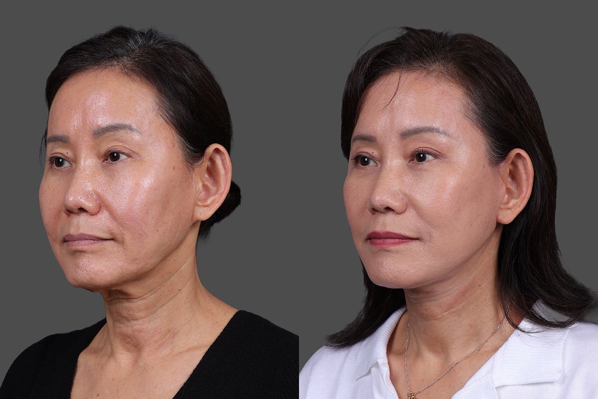Facelift Before & After Gallery - Patient 231404 - Image 4