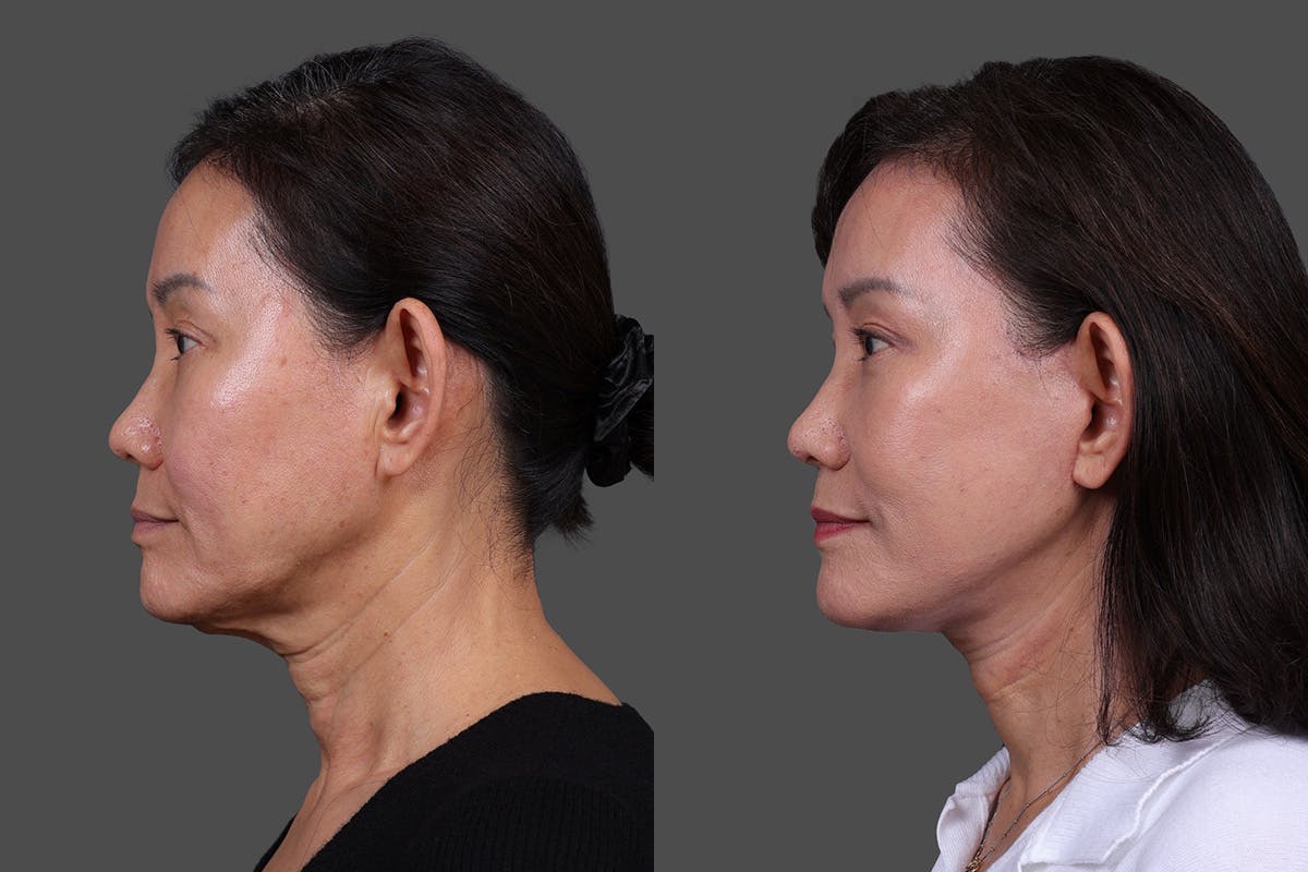 Facelift Before & After Gallery - Patient 231404 - Image 5