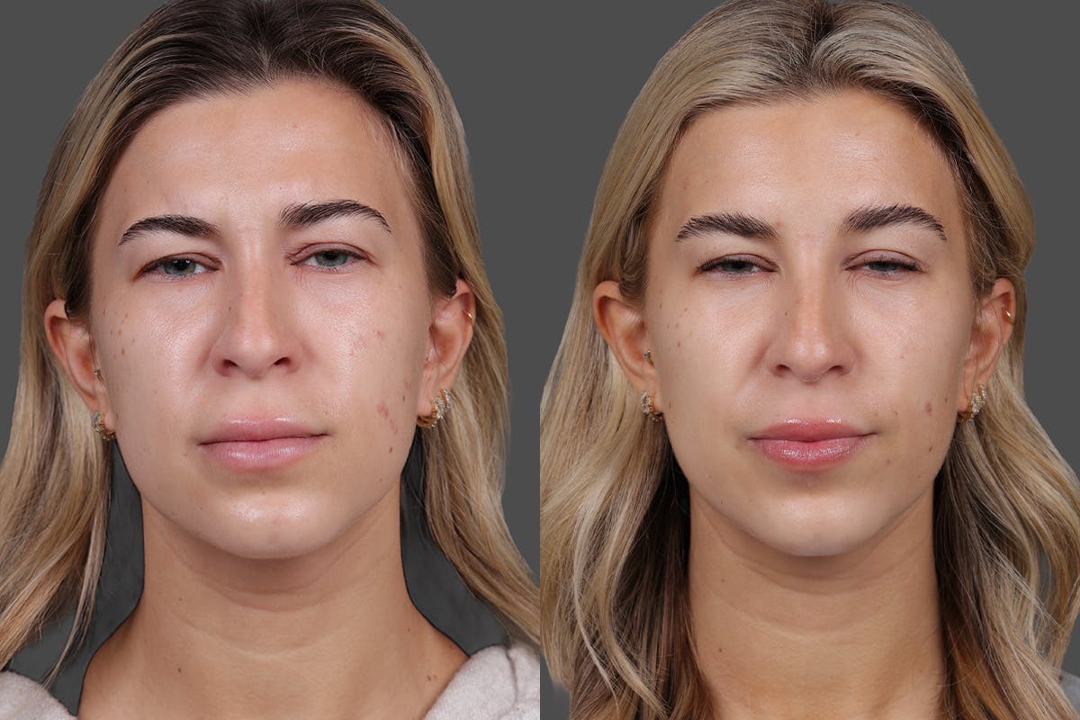 BOTOX® Before & After Gallery - Patient 249332 - Image 3