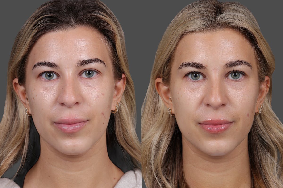 BOTOX® Before & After Gallery - Patient 249332 - Image 1