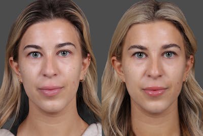 BOTOX® Before & After Gallery - Patient 249332 - Image 1