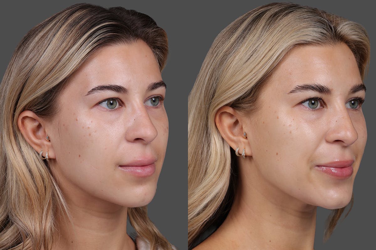 BOTOX® Before & After Gallery - Patient 249332 - Image 4