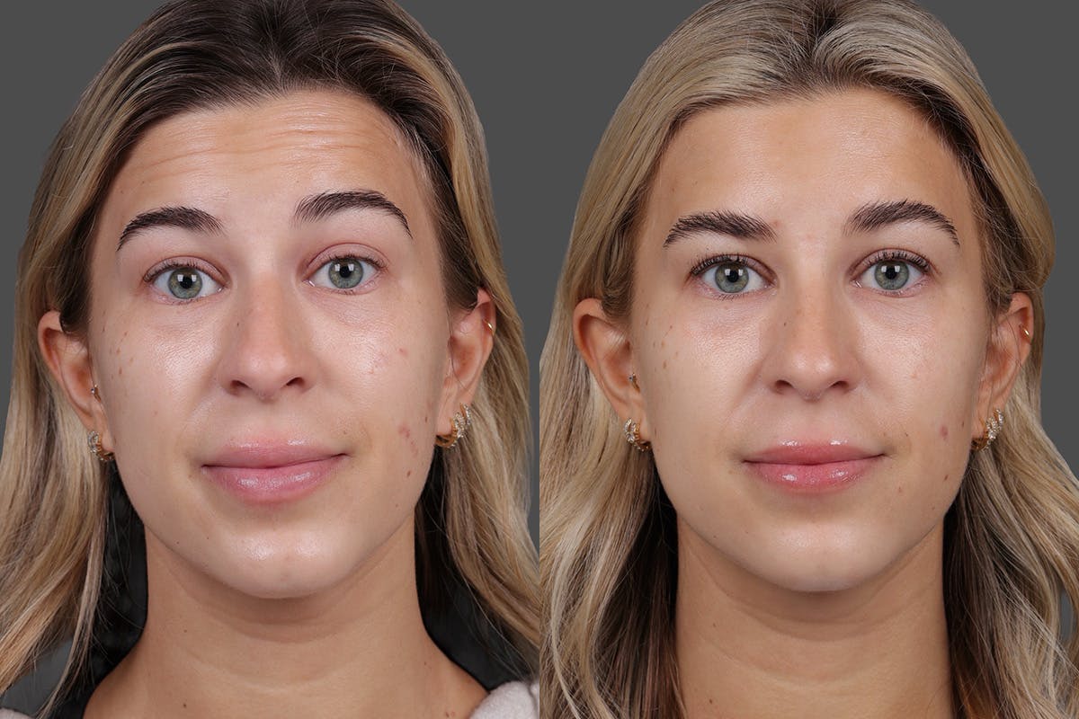 BOTOX® Before & After Gallery - Patient 249332 - Image 2