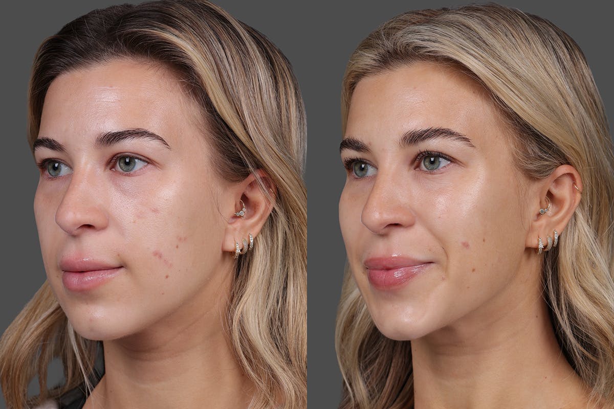 BOTOX® Before & After Gallery - Patient 249332 - Image 5