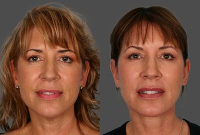 Acne Scarring Before & After Gallery - Patient 207503 - Image 1