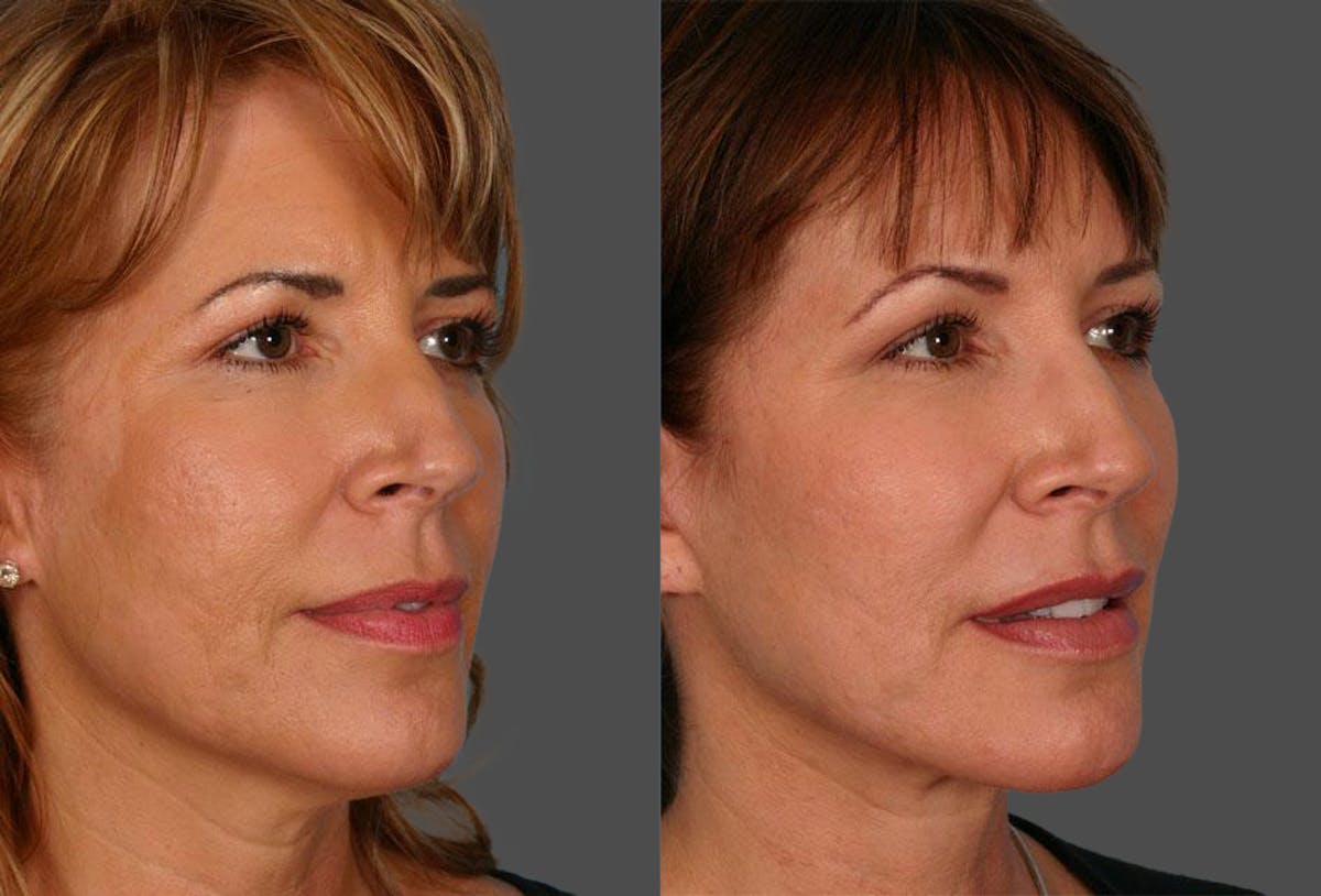 Acne Scarring Before & After Gallery - Patient 207503 - Image 2