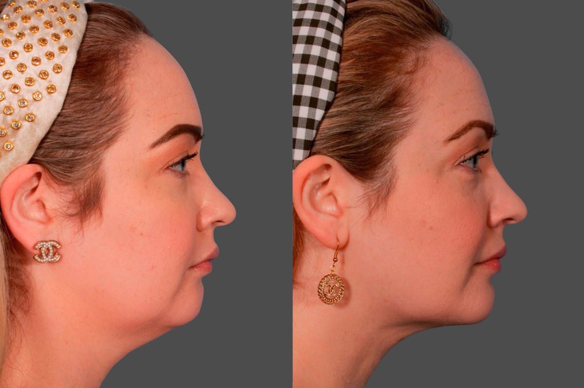 Chin and Cheek Augmentation Before & After Gallery - Patient 136652 - Image 2