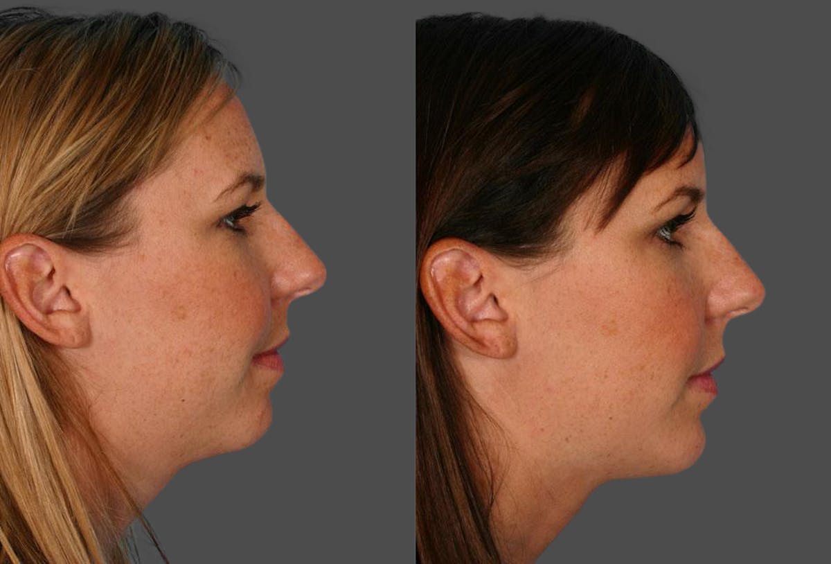 Chin and Cheek Augmentation Before & After Gallery - Patient 172182 - Image 1