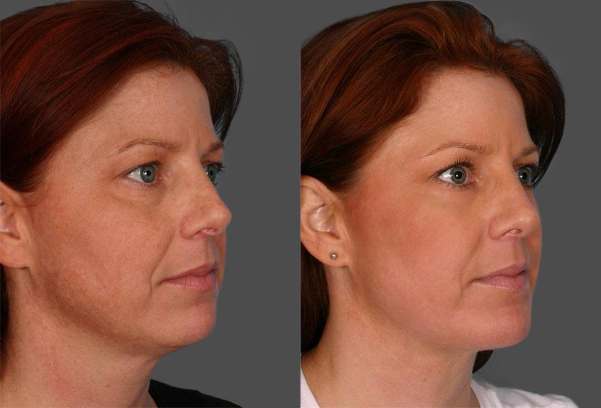 Chin and Cheek Augmentation Before & After Gallery - Patient 187807 - Image 2