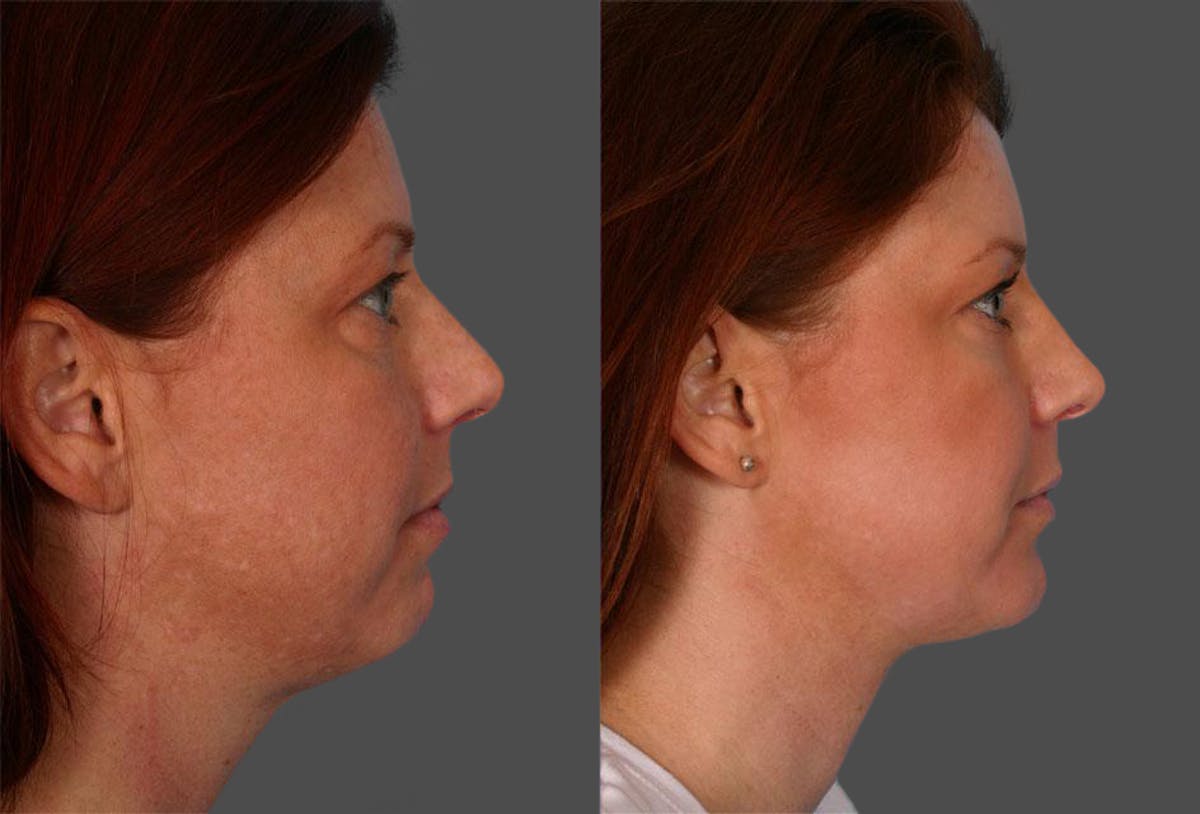 Chin and Cheek Augmentation Before & After Gallery - Patient 187807 - Image 3