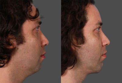 Chin and Cheek Augmentation Before & After Gallery - Patient 195093 - Image 1