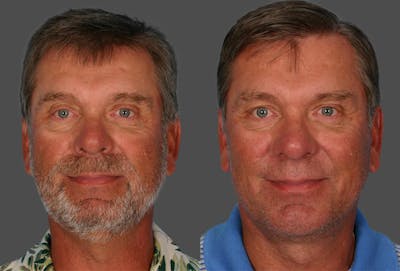 Chin and Cheek Augmentation Before & After Gallery - Patient 282944 - Image 1