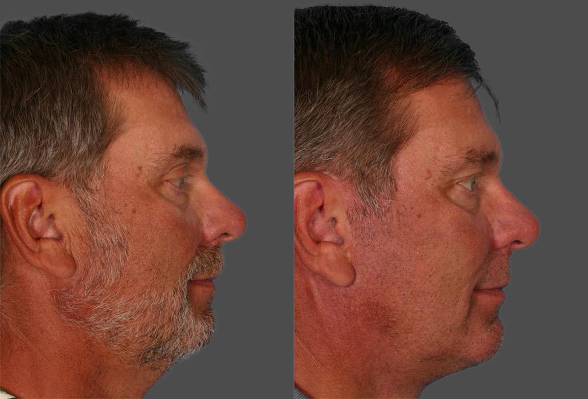 Chin and Cheek Augmentation Before & After Gallery - Patient 282944 - Image 2