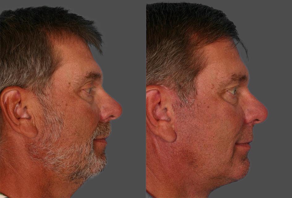 Chin and Cheek Augmentation Before & After Gallery - Patient 282944 - Image 2
