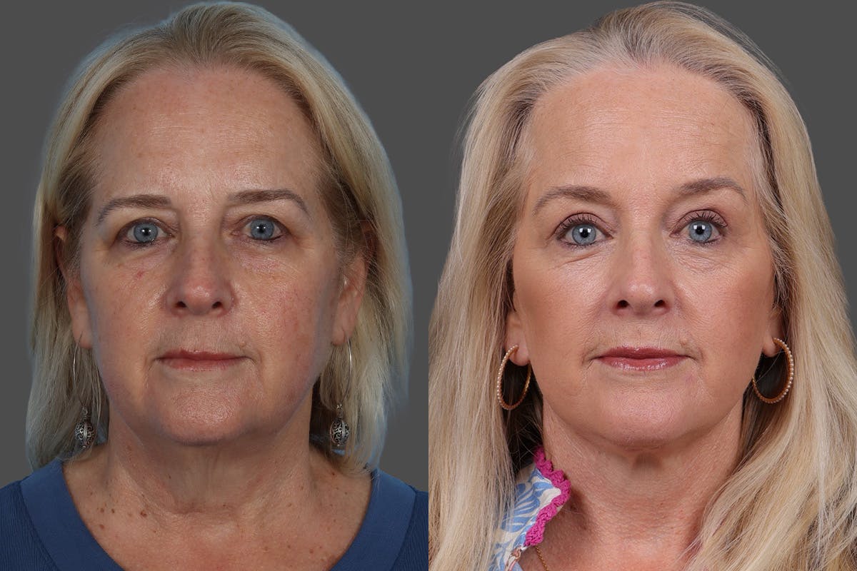 Eyelid Surgery (Blepharoplasty) Before & After Gallery - Patient 112278 - Image 1