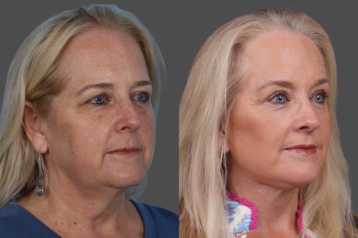 Eyelid Surgery (Blepharoplasty) Before & After Gallery - Patient 112278 - Image 2