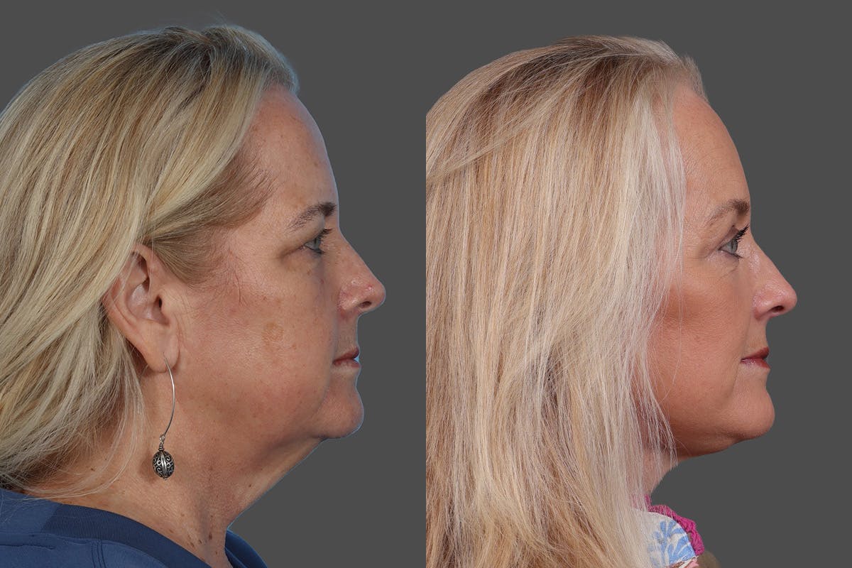 Eyelid Surgery (Blepharoplasty) Before & After Gallery - Patient 112278 - Image 3