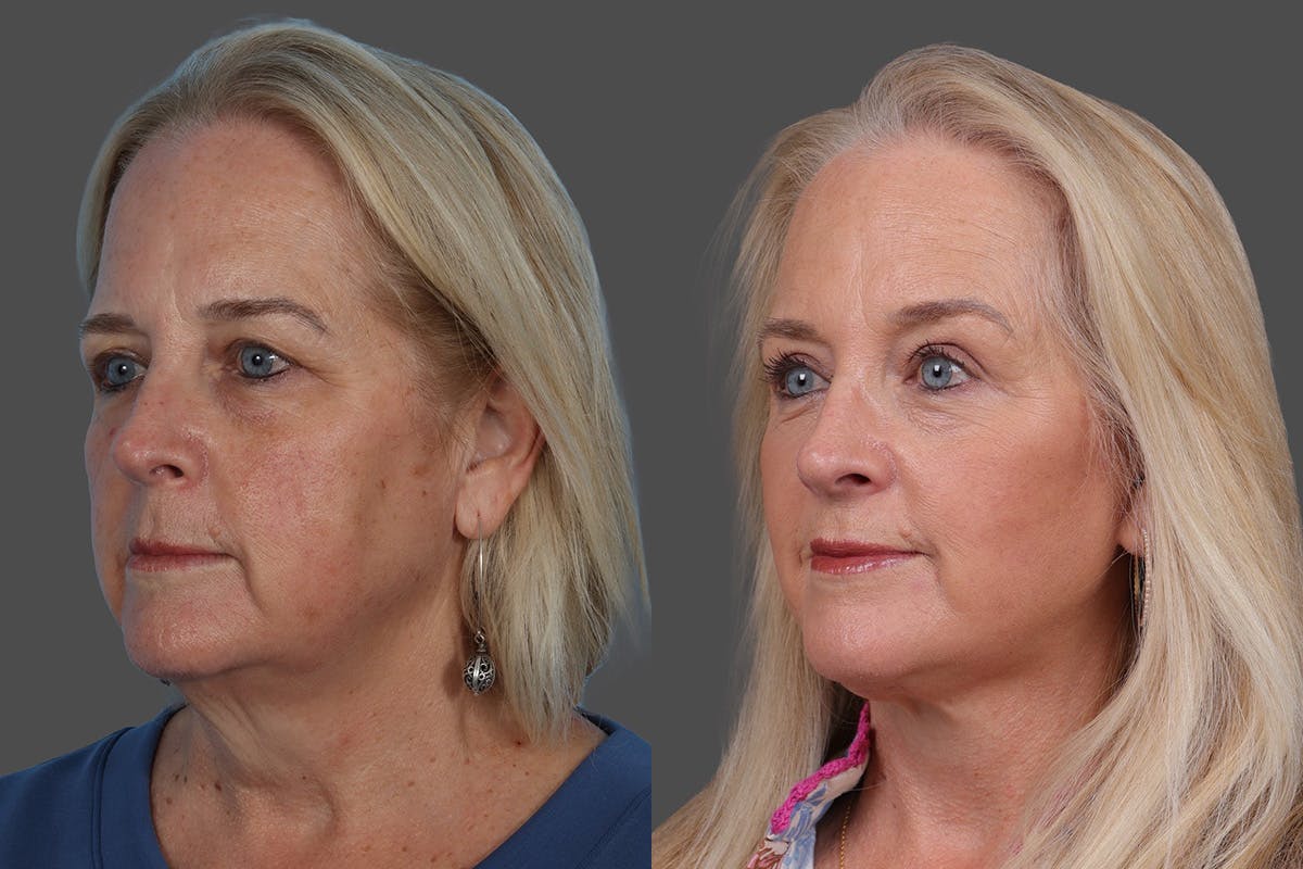 Eyelid Surgery (Blepharoplasty) Before & After Gallery - Patient 112278 - Image 4