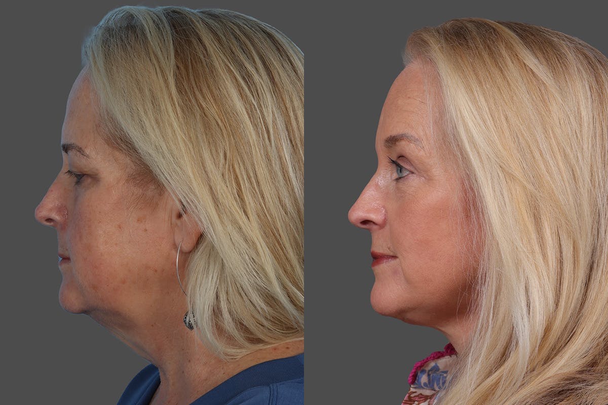 Eyelid Surgery (Blepharoplasty) Before & After Gallery - Patient 112278 - Image 5