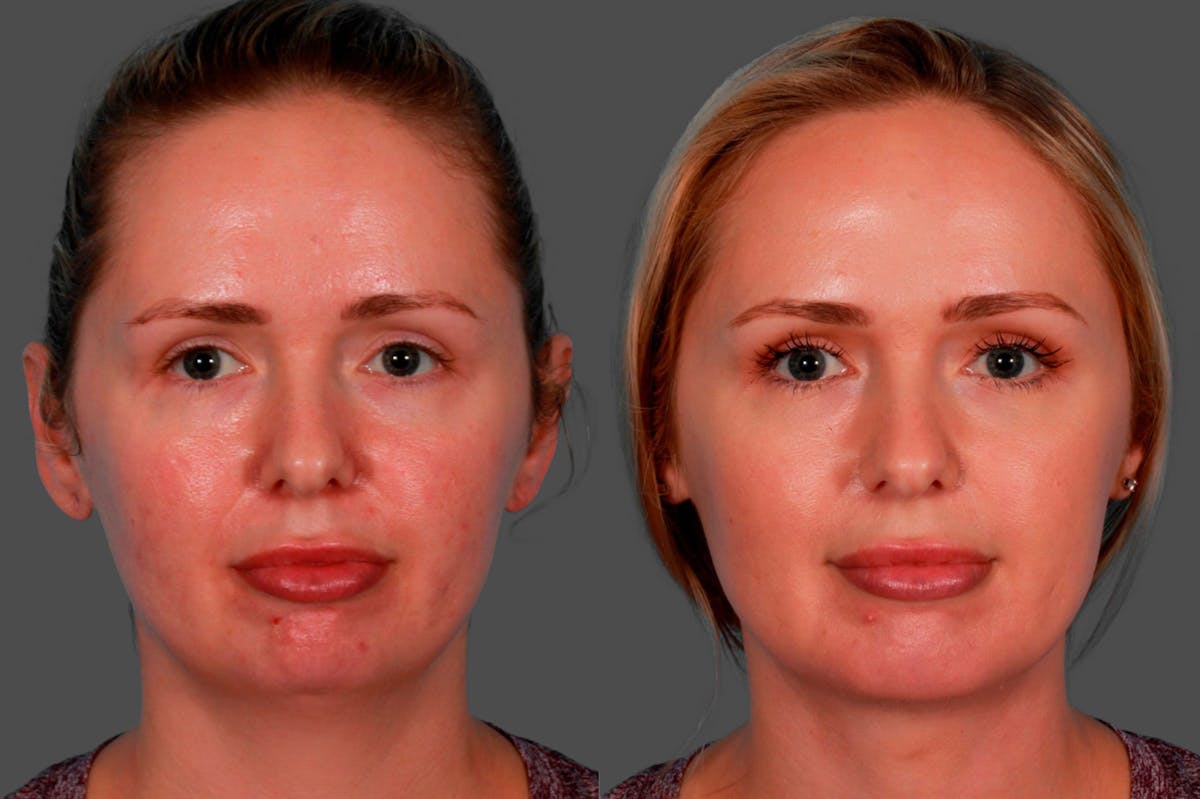 Chin and Cheek Augmentation Before & After Gallery - Patient 349786 - Image 1