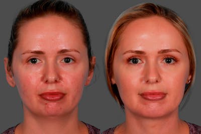 Chin and Cheek Augmentation Before & After Gallery - Patient 349786 - Image 1