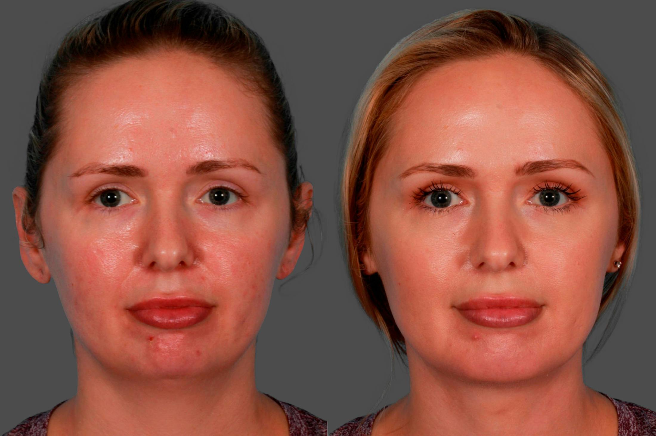 Chin and Cheek Augmentation Before & After Gallery - Patient 349786 - Image 1