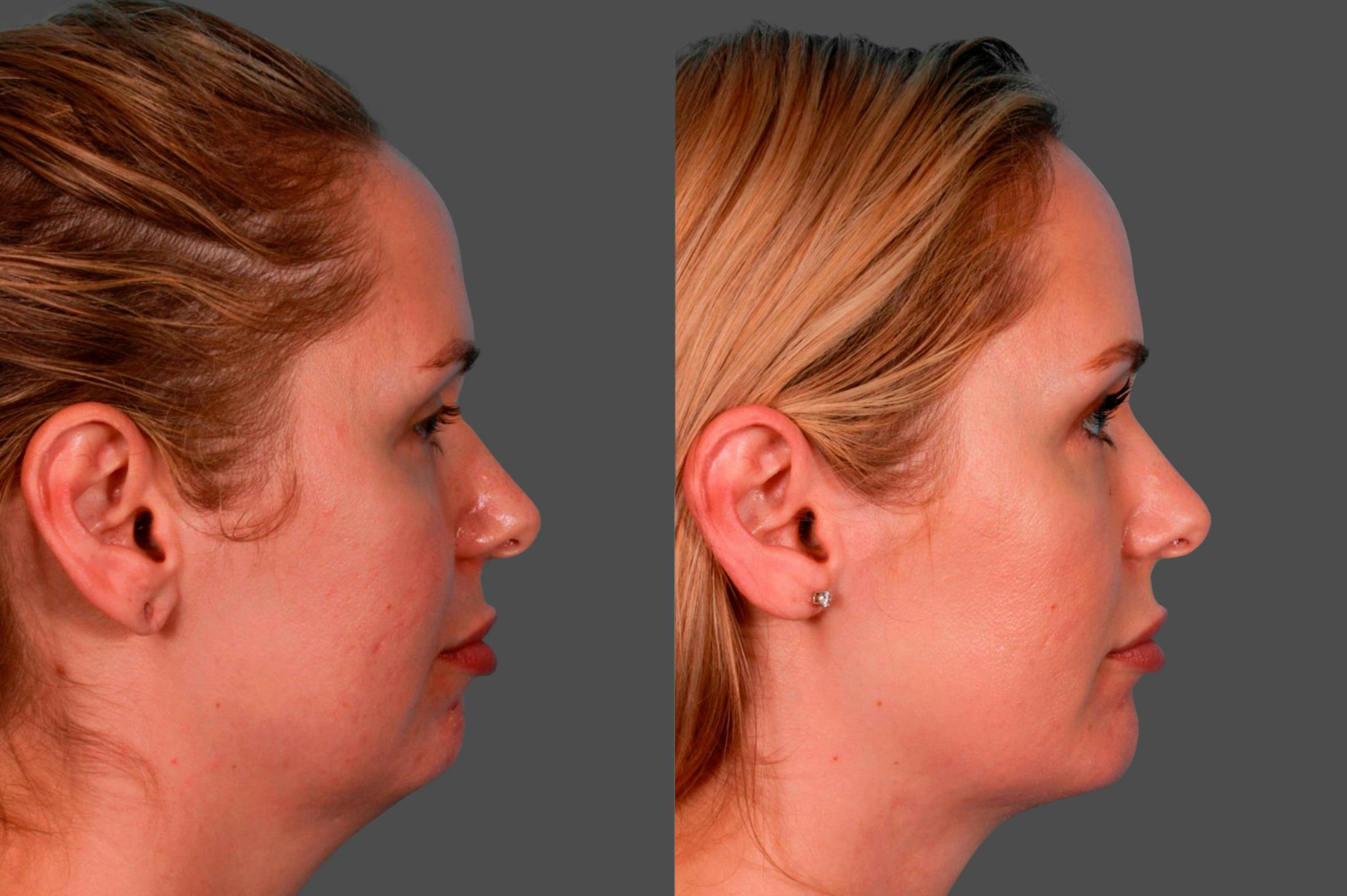 Chin and Cheek Augmentation Before & After Gallery - Patient 349786 - Image 2