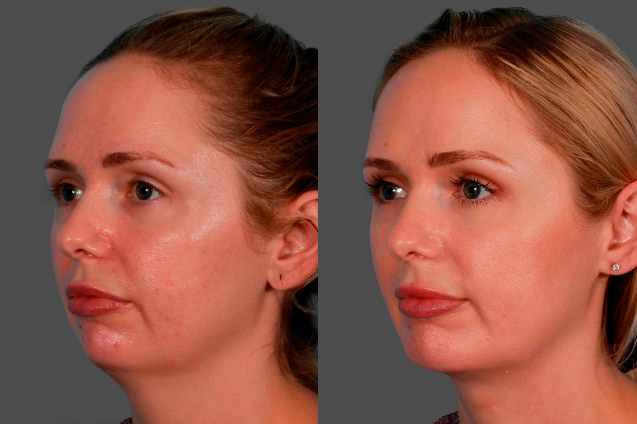 Chin and Cheek Augmentation Before & After Gallery - Patient 349786 - Image 3