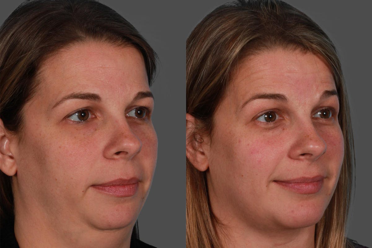 Chin and Cheek Augmentation Before & After Gallery - Patient 402023 - Image 2