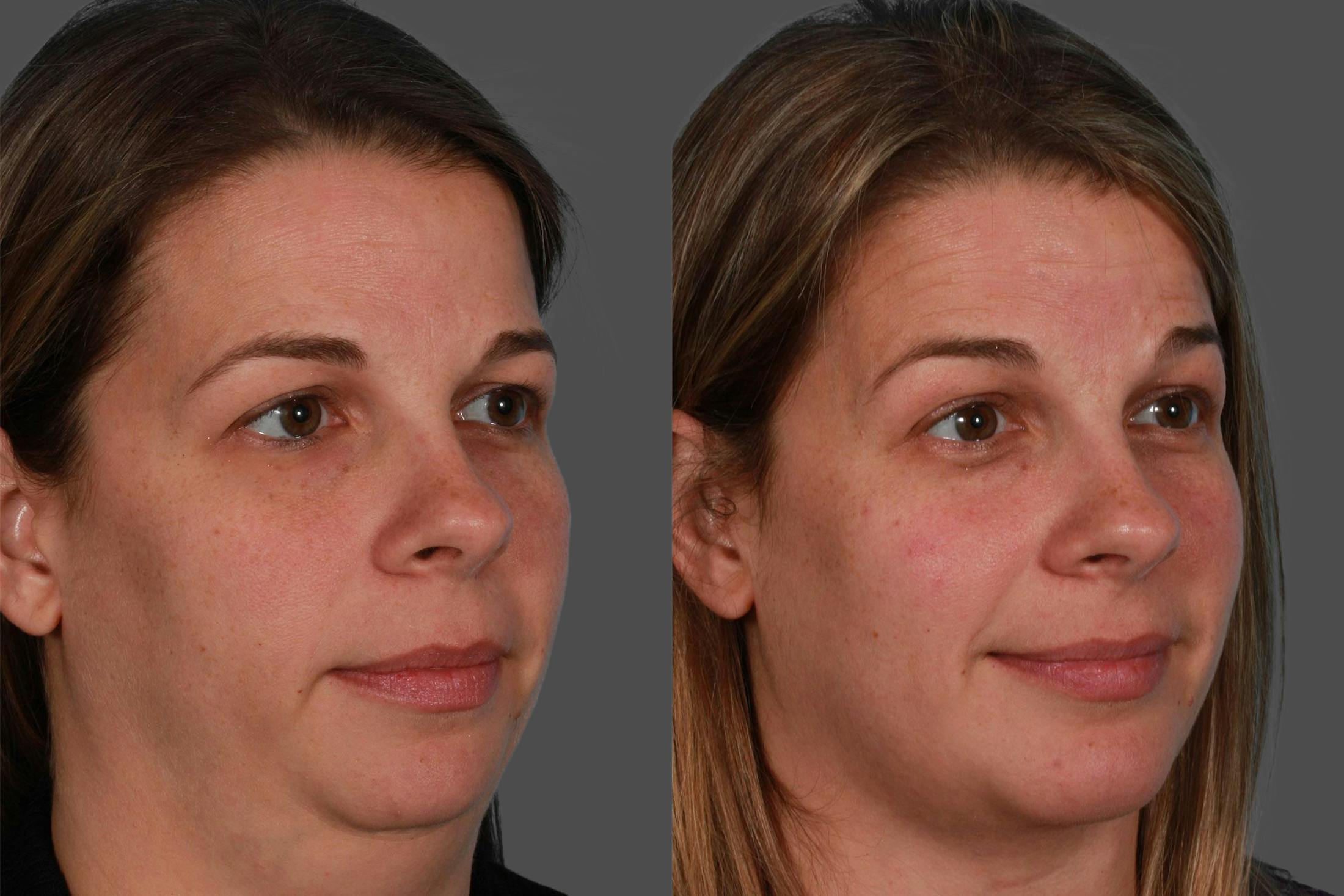 Chin and Cheek Augmentation Before & After Gallery - Patient 402023 - Image 2