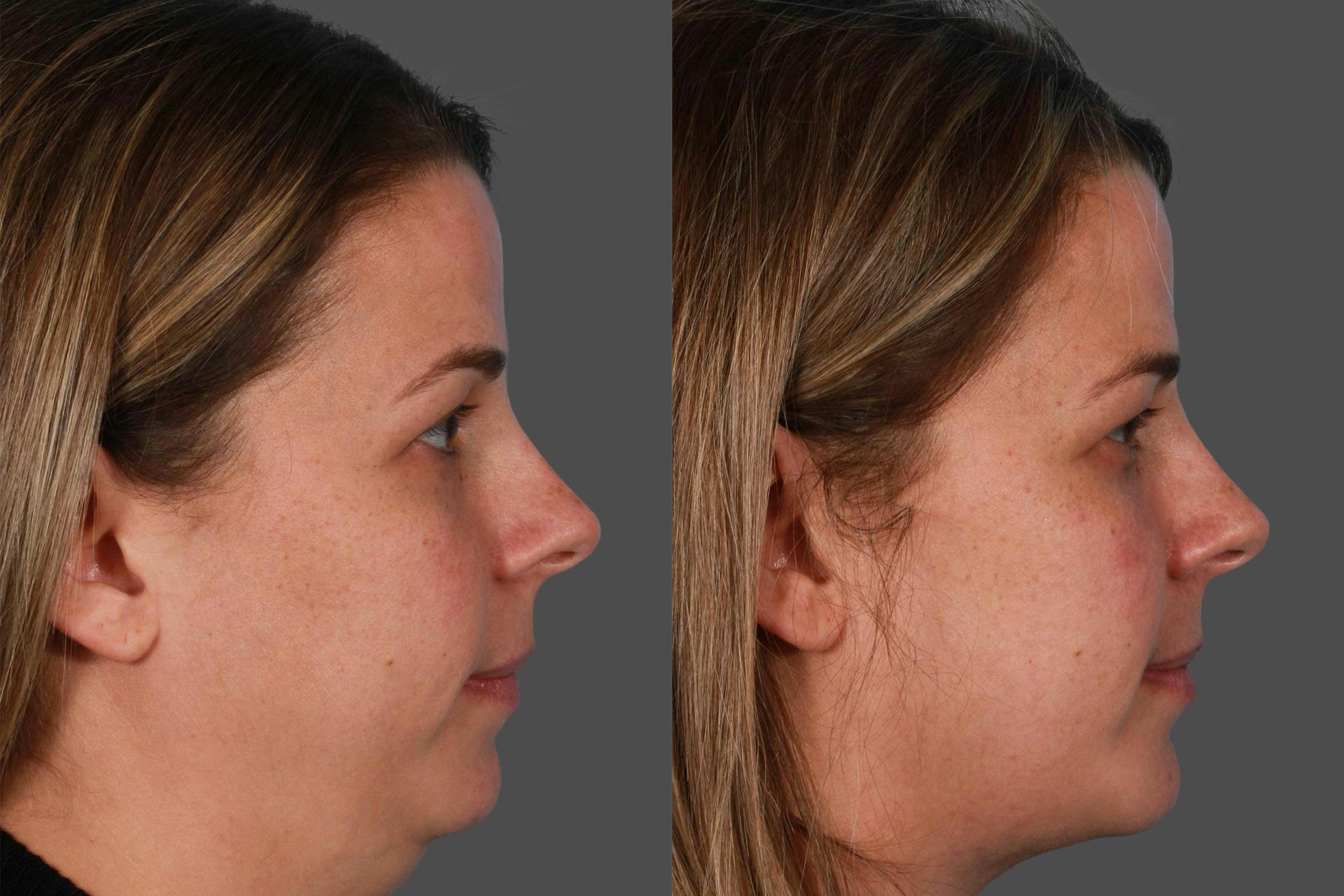 Chin and Cheek Augmentation Before & After Gallery - Patient 402023 - Image 3