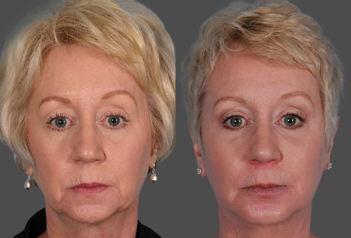Chin and Cheek Augmentation Before & After Gallery - Patient 413096 - Image 1