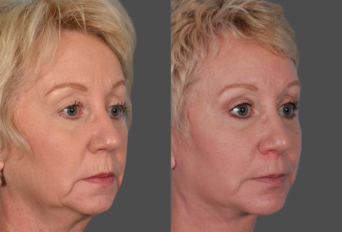 Chin and Cheek Augmentation Before & After Gallery - Patient 413096 - Image 2