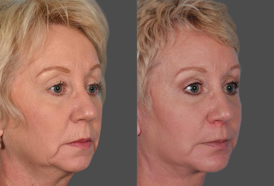 Chin and Cheek Augmentation Before & After Gallery - Patient 413096 - Image 2