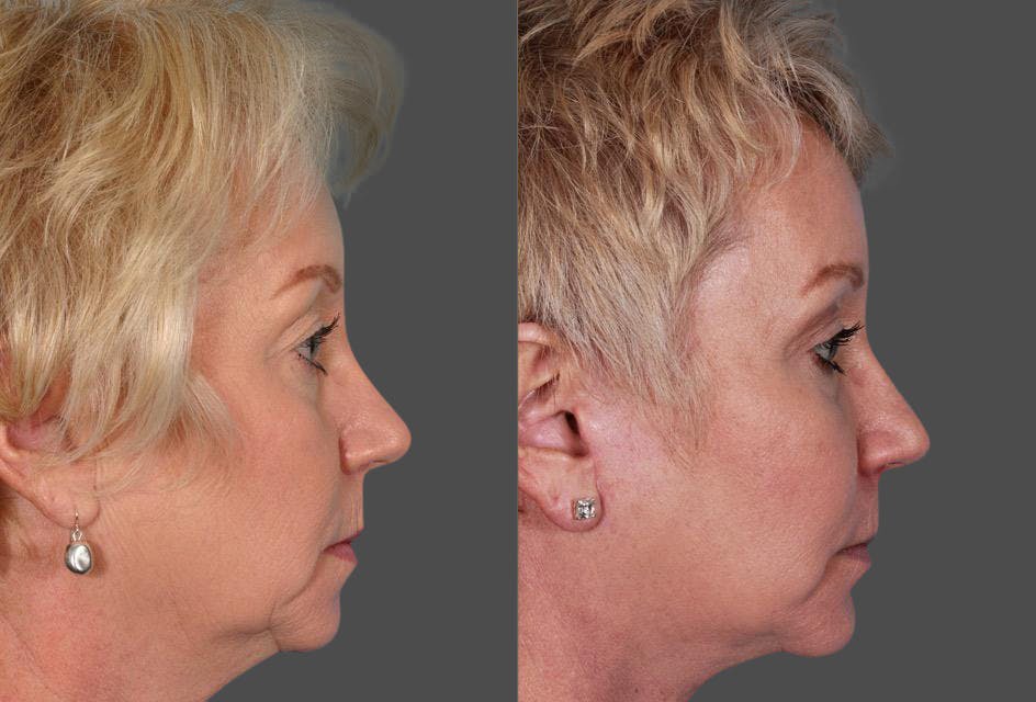 Chin and Cheek Augmentation Before & After Gallery - Patient 413096 - Image 3