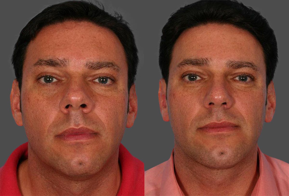 Chin and Cheek Augmentation Before & After Gallery - Patient 420478 - Image 1