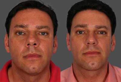 Chin and Cheek Augmentation Before & After Gallery - Patient 420478 - Image 1